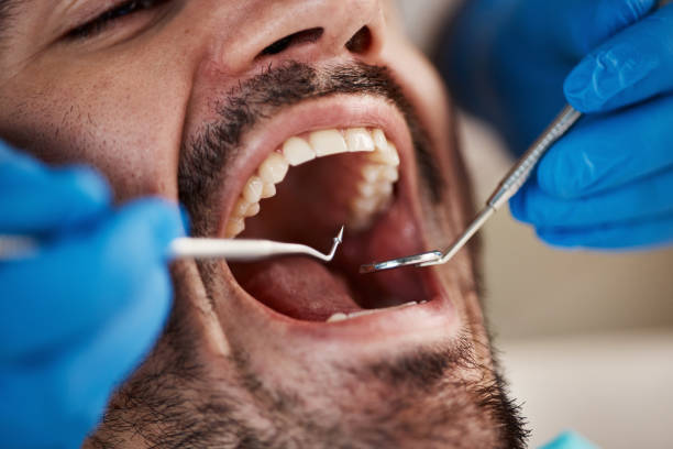Best Emergency Wisdom Teeth Removal in Appleton, WI